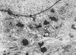 F,56y. | nemaline myopathy v.s. F,56y. | nemaline myopathy v.s.